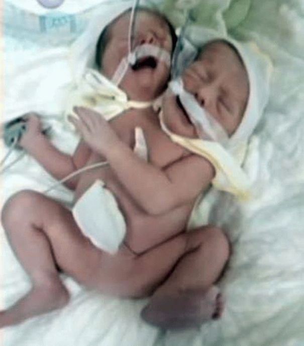 Украинцам впервые показали фото сиамских близнецов из Черновцов